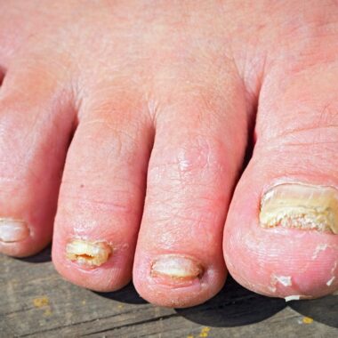4 Signs You Have A Fungal Nail Infection – And How To Stop It