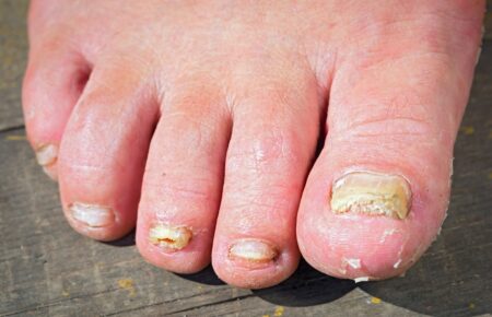 What Is The Most Effective Treatment For Fungal Nail Infections?